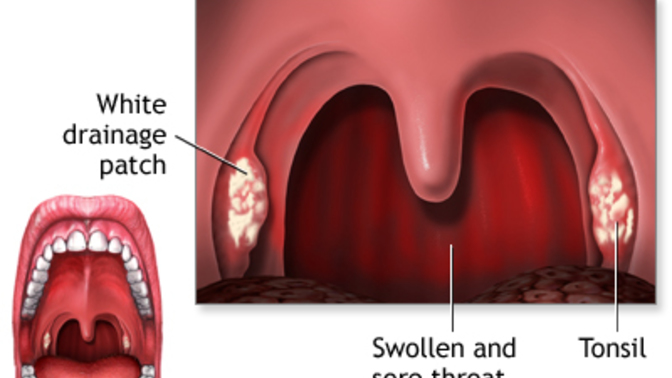Do you have your tonsils, why or why not?