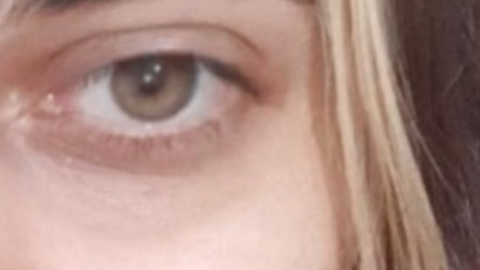 Why do I have massive eye bags at 21?