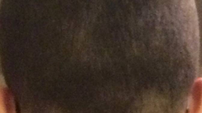 Why are parts of my head patchy?