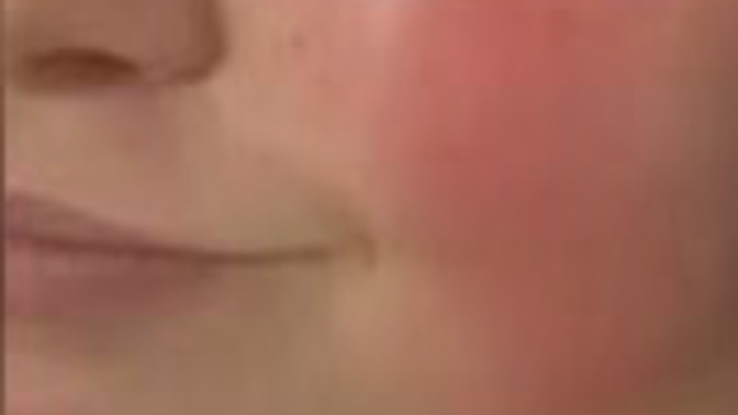 Red Cheeks? Thoughts or Advice?