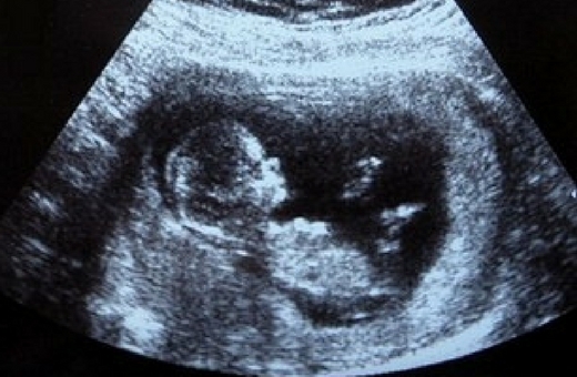 11 weeks, 3 days