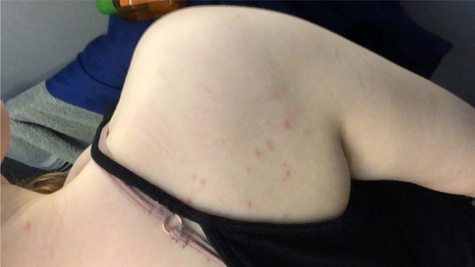 What kind of bug bites are these?