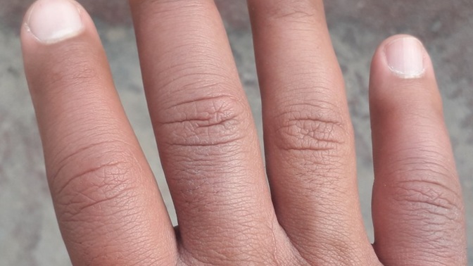 Why my fingers becomes like this in the cold weather?