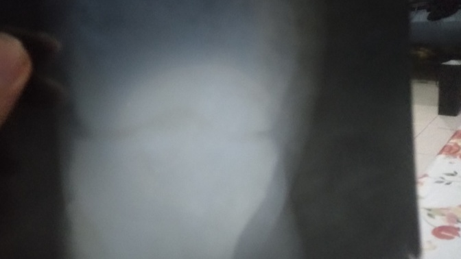 Hey everyone can anyone help me to get 2 medicine for my knee erosion?