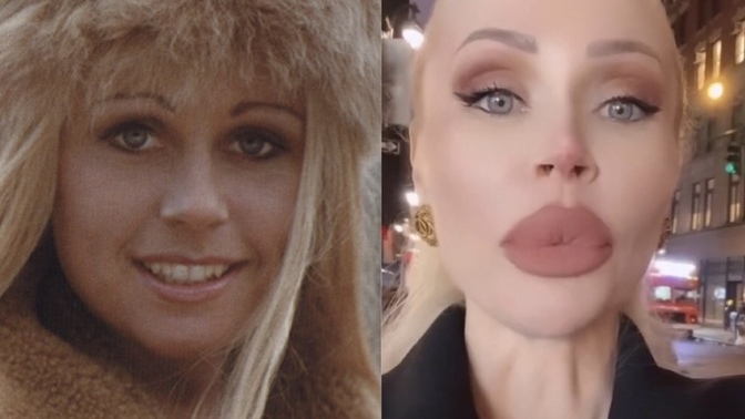 Does she look more beautiful with big lips?