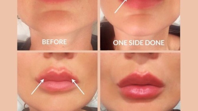 Why do woman want lip filler?