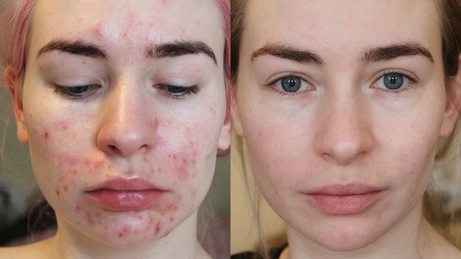 Has anyone here ever used Roaccutane?