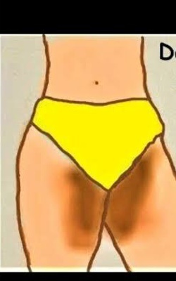 Why do I get dark spots at my inner thighs and buttocks?