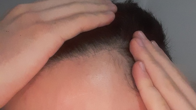 Do you guys think my hair is normal or should I seek medical help? ?
