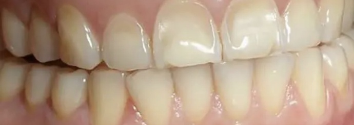 How yellow is too yellow when it comes to teeth in a potential partner?