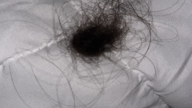 Why am I losing a lot of hair ( details & picture) ?