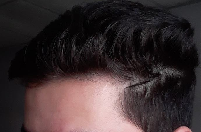 I have very serious concerns about the future of my hair. Do you think I will go bald? ?