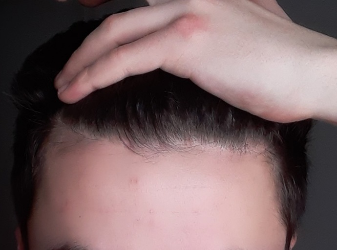 I have very serious concerns about the future of my hair. Do you think I will go bald? ?