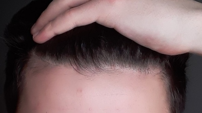 I have very serious concerns about the future of my hair. Do you think I will go bald? ?