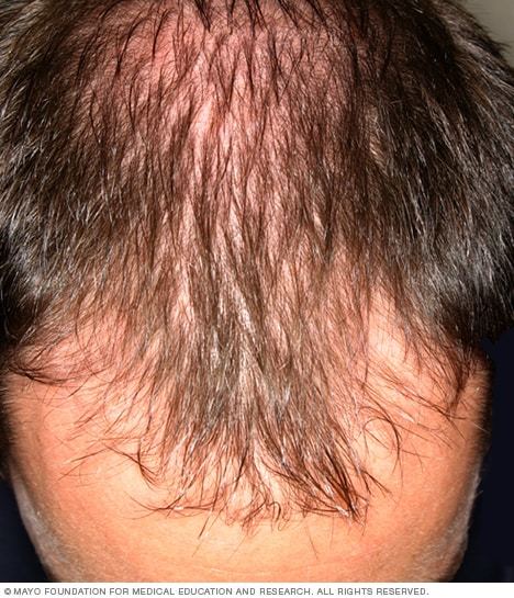 Do you have a bald patch?