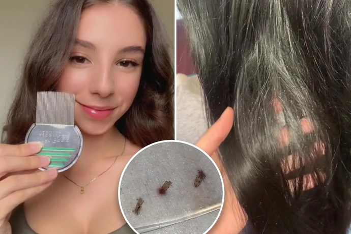 You’ve met the love of your life but they struggle with constant hair lice. Could you deal with that?