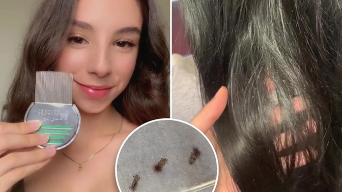 You’ve met the love of your life but they struggle with constant hair lice. Could you deal with that?