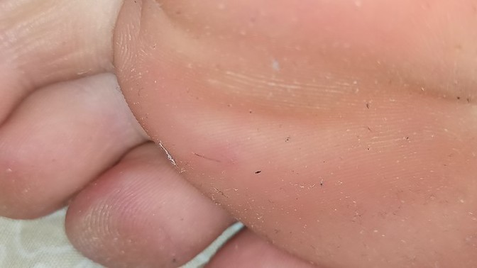 Got a hair stuck in my foot, how to remove?