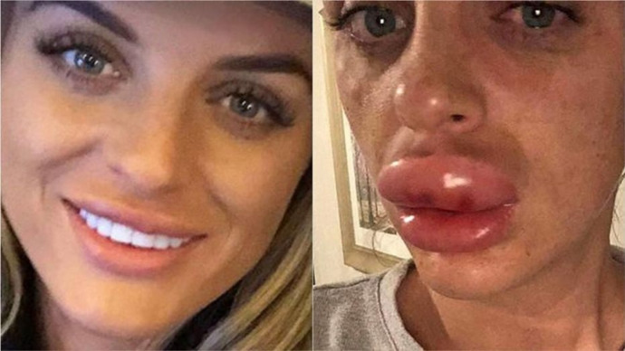 My lower lip looked like this lady's upper lip in that right hand photo. It was swollen af.