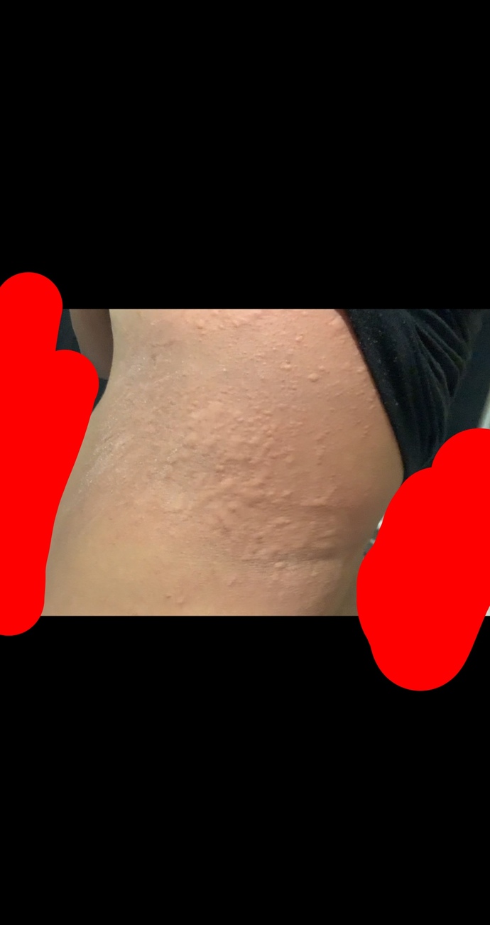 Random skin bump on both of my sides?