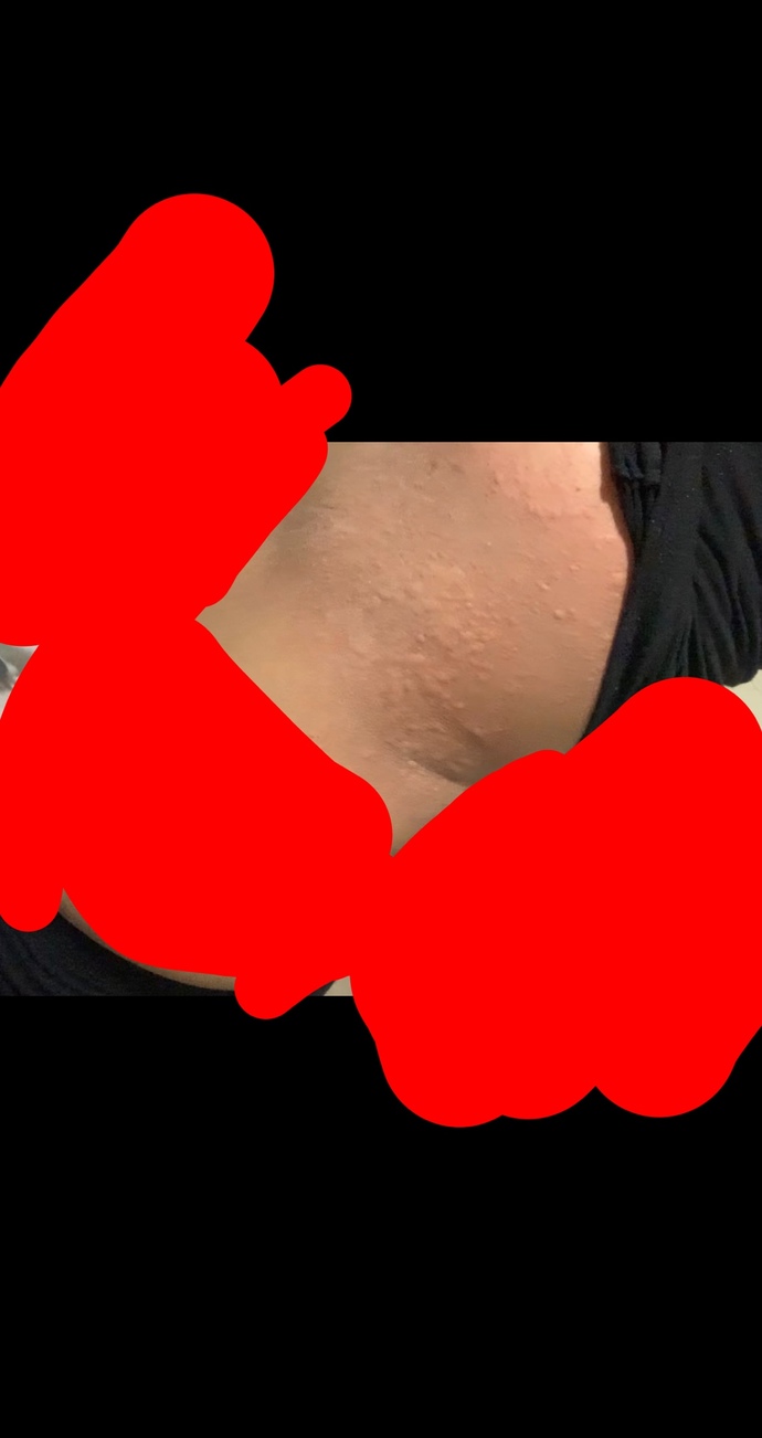 Random skin bump on both of my sides?