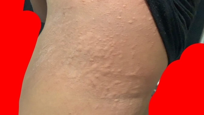 Random skin bump on both of my sides?