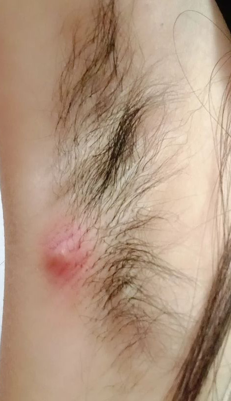 How can she treat this?