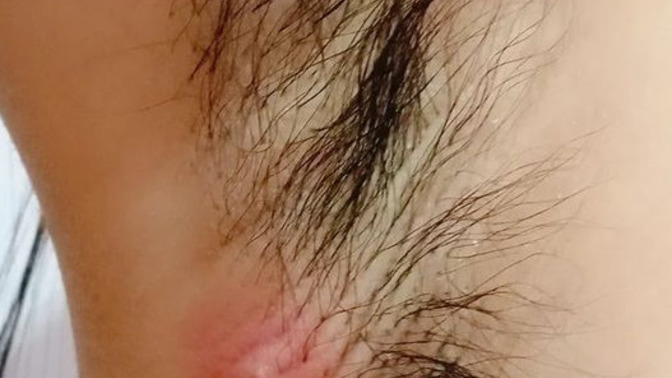 How can she treat this?