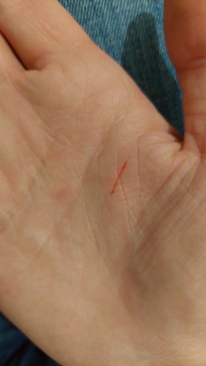 Mysterious scar occurred on my palm, what does it mean?