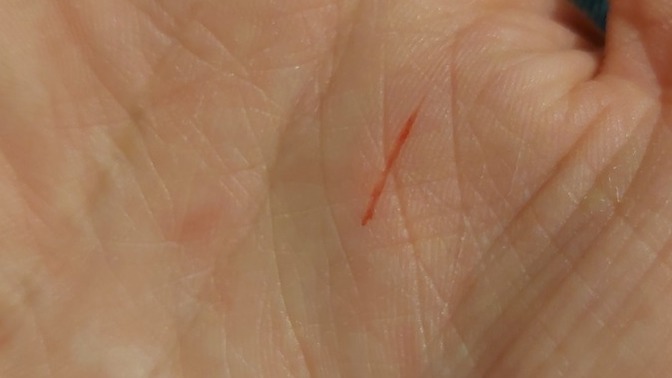 Mysterious scar occurred on my palm, what does it mean?