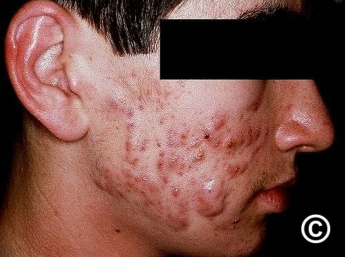 Would you date someone with heavy acne?