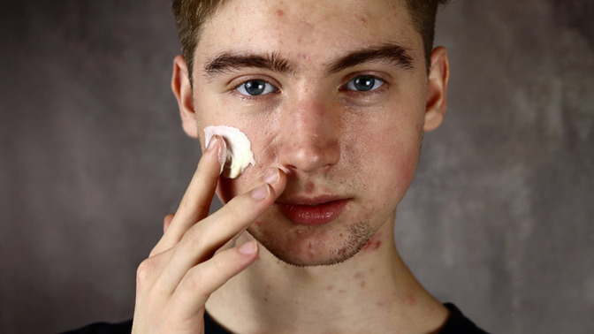 Would you date someone with heavy acne?