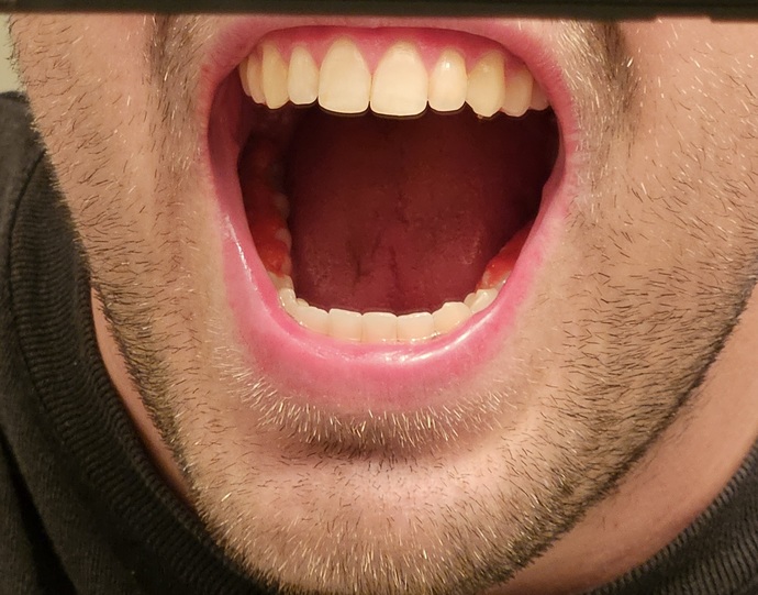 Should I go for my tooth cleaning with Chesters Hot Fries stuck in my teeth?