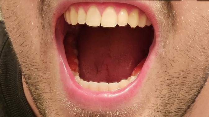 Should I go for my tooth cleaning with Chester's Hot Fries stuck in my teeth?