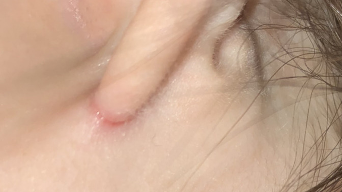 Does anyone else with unattached earlobes experience this?
