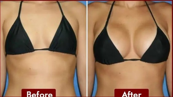 What Is Your Opinion Of An Older (50+) Getting A Boob Job?