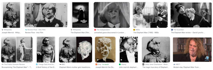 this is what Joseph Merrick looks like