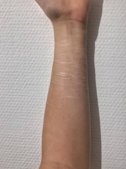 What would you think if you notice a visible self harm scar of a person?