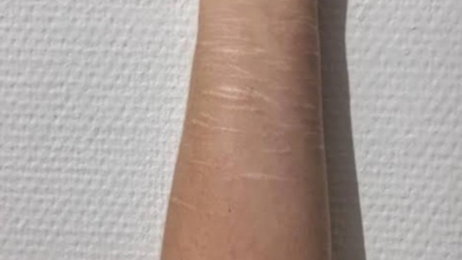 What would you think if you notice a visible self harm scar of a person?