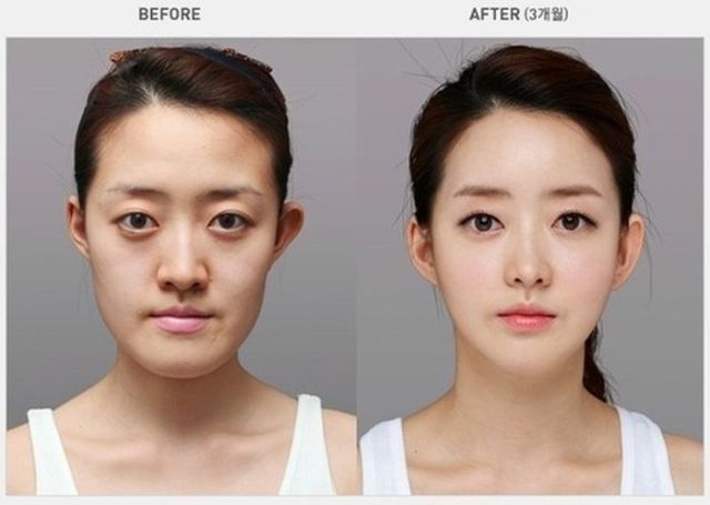 Does plastic surgery work?