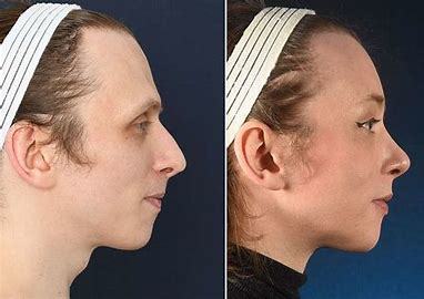 Does plastic surgery work?