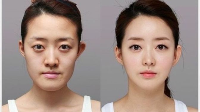Does plastic surgery work?