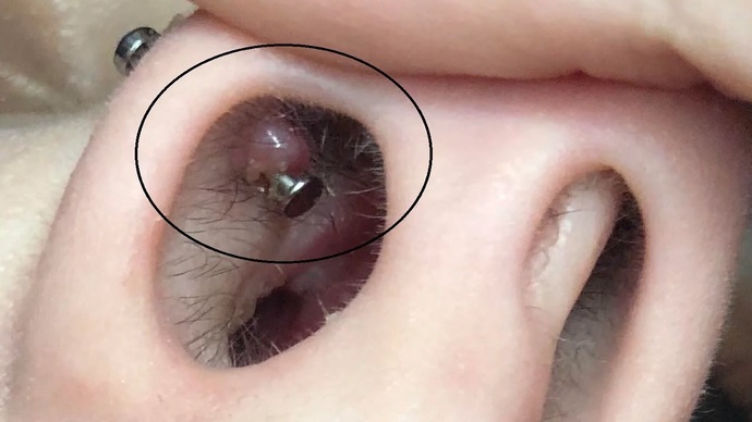 How to heal nostril piercing bump inside nose?