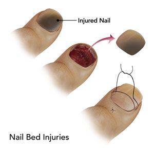 I think my nail bed broke, how to fix or help with pain?