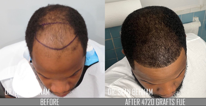 Should I get a hair transplant or just stay bald?