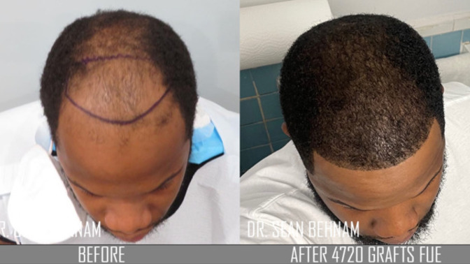 Should I get a hair transplant or just stay bald?