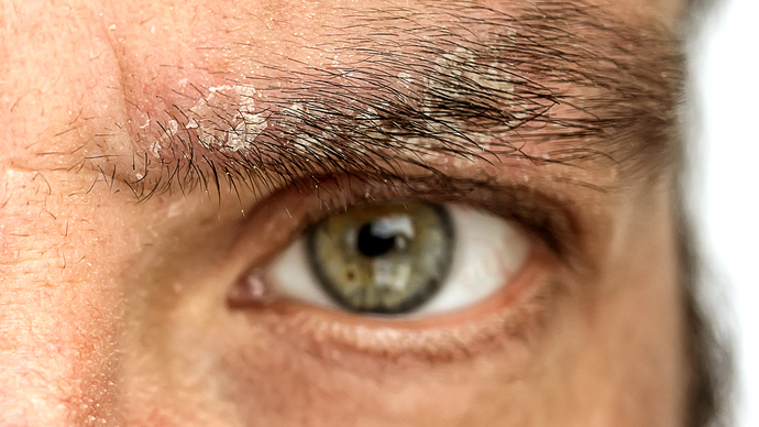 I have seborrheic dermatitis how can I cure it?
