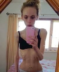 Which one would you choose? A girl with anorexia or a girl whose obese?