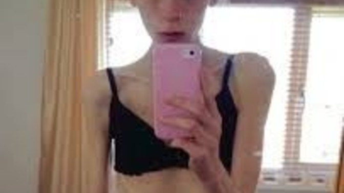 Which one would you choose? A girl with anorexia or a girl whose obese?