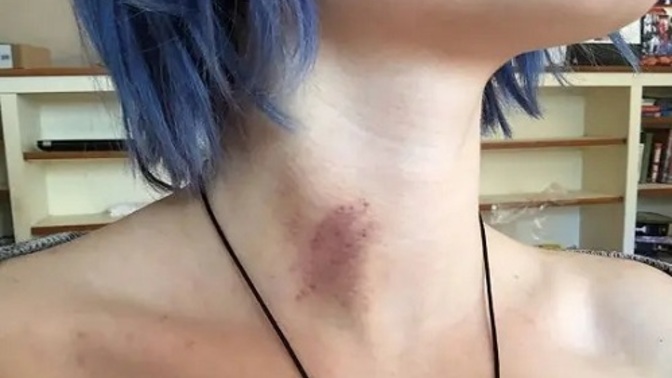 How do I hide a hickey?